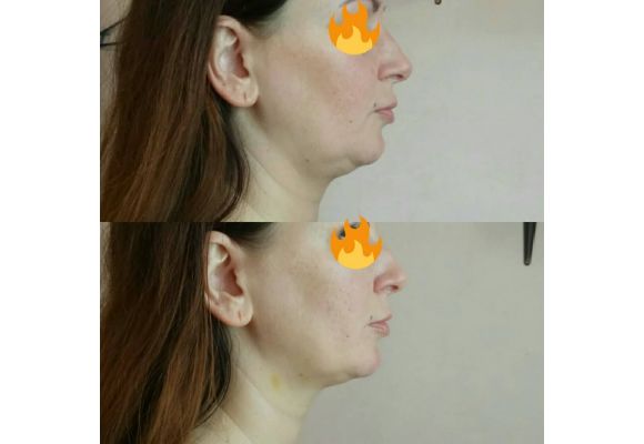 До процедуры